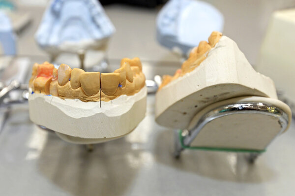 A dental prosthesis
