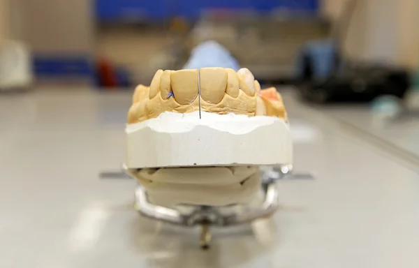 Prótesis dental para prótesis dentaria superior en boca . — Foto de Stock