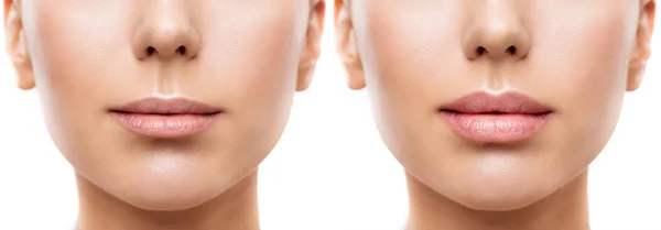 Woman Lips Voor Fillers Volledige Lip Thin Lip Augmentation Vrouwen — Stockfoto