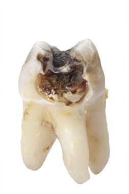 Extracted tooth