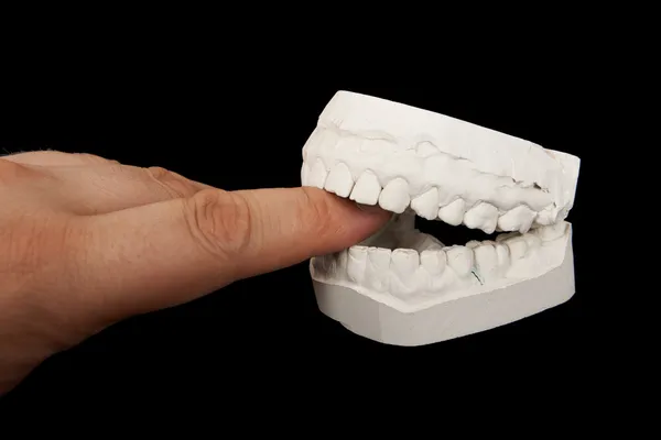 Plaster jaw biting human finger. — Stock Photo, Image