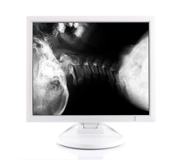 X-ray beeld en computer — Stockfoto