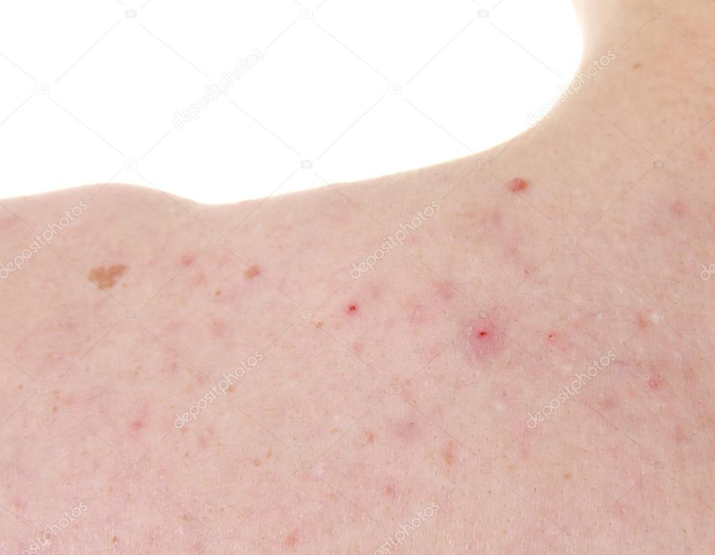 Acne on the shoulders of a young boy