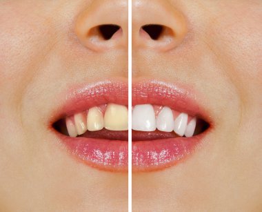 Teeth before and after whitening clipart