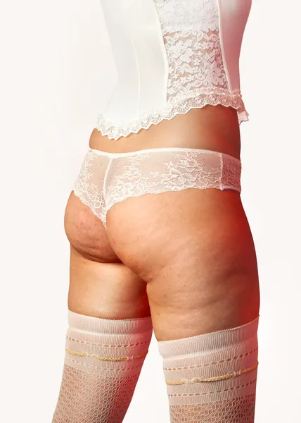 셀 룰 라이트와 엉덩이 — 스톡 사진