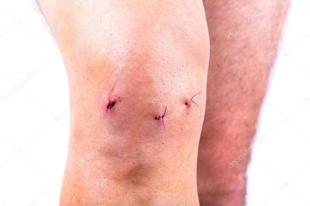 Man knee after arthroscopic surgery