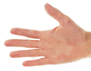 Eczema Dermatitis on Palm of Hand and Fingers clipart