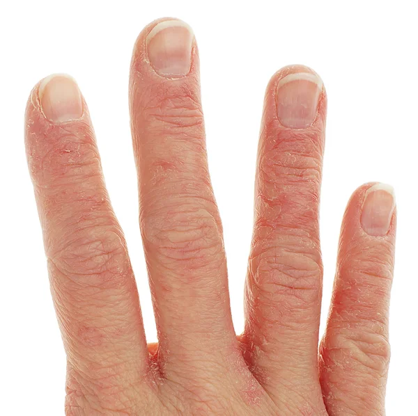 Närbild av eksem dermatit på fingrarna — Stockfoto