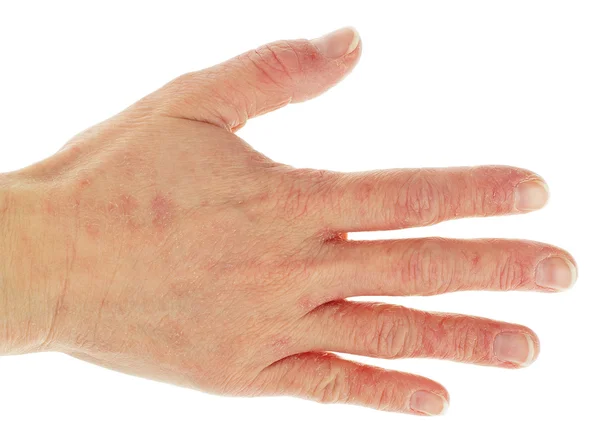 Dermatite eczéma au dos de la main et des doigts — Photo