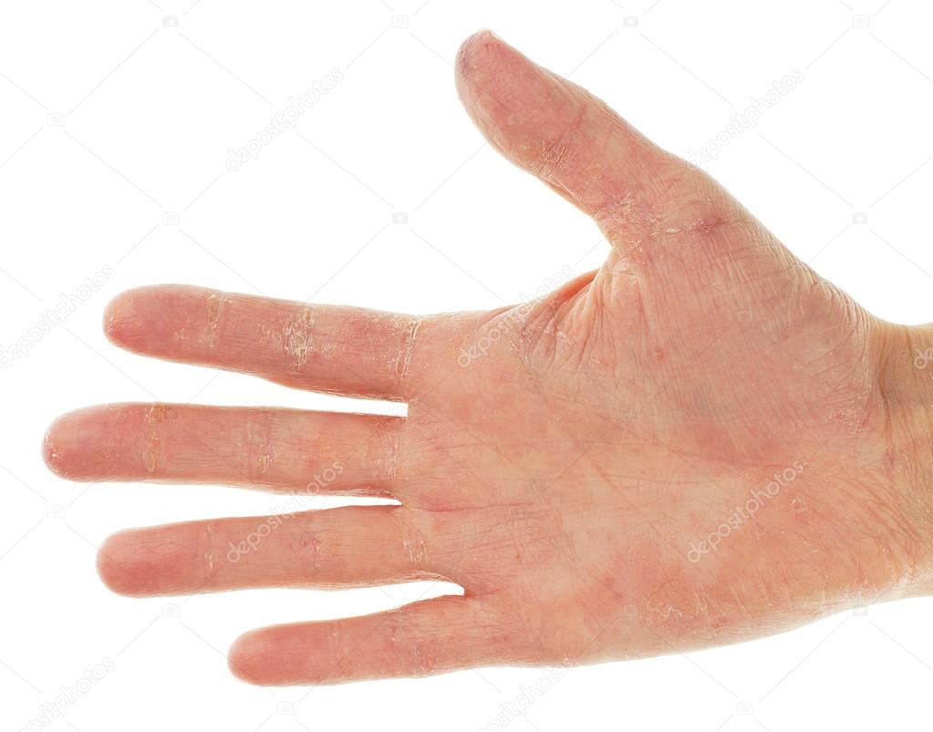Eczema Dermatitis on Palm of Hand and Fingers