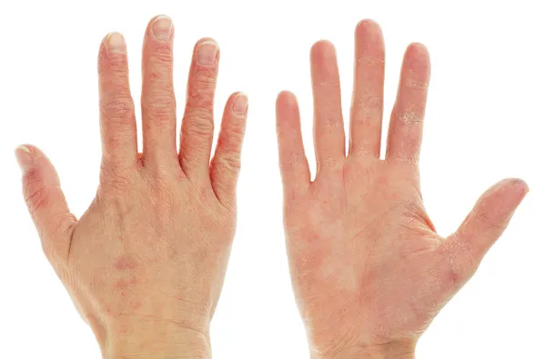 Dermatitis por eccema en frente y dorso de la mano — Foto de Stock