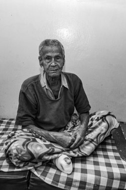 Sundarpur, Hindistan - 2013: Hindistan 'ın Bihar eyaletindeki yerel bir cüzzamlı hastanesinde kimliği belirsiz Hintli cüzzamlı hasta.