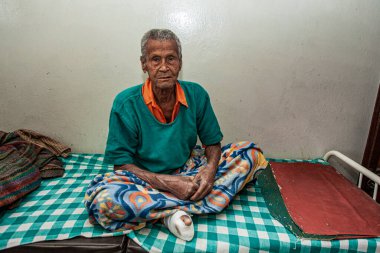 Sundarpur, Hindistan - 2013: Hindistan 'ın Bihar eyaletindeki yerel bir cüzzamlı hastanesinde kimliği belirsiz Hintli cüzzamlı hasta.