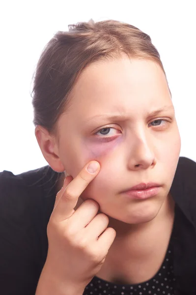 Teen girl with a problem skin — Stock Photo, Image