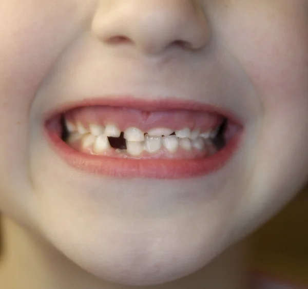 Elveszett fogak — Stock Fotó