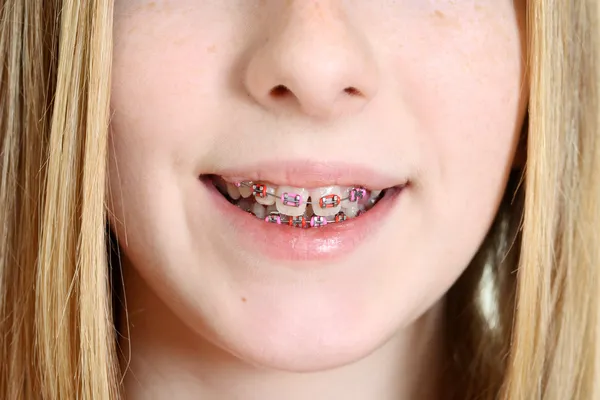 Closeup teen girl with braces — Stock Photo, Image