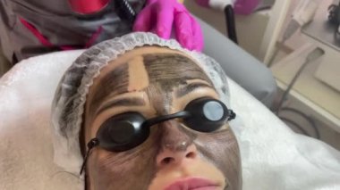 Karbon yüz soyma prosedürü. Lazer darbeleri yüz derisini temizler. Donanım kozmetoloji tedavisi. Fototermoliz süreci, deriyi ısıtma, lazer karbon soyma. Yüz yenileme..
