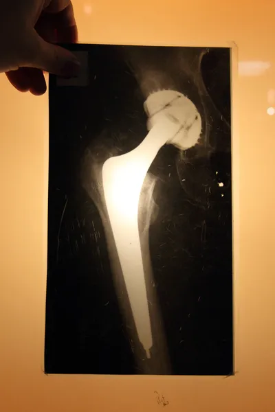 股関節 endoprosthese の x 線 — ストック写真