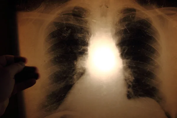 X-ray of lungs — Stock Photo, Image