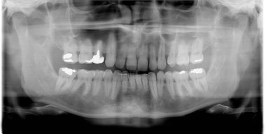 RTG (x-ray) foto van man tanden 