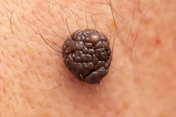cilt üzerinde büyük bir köstebek. Makro