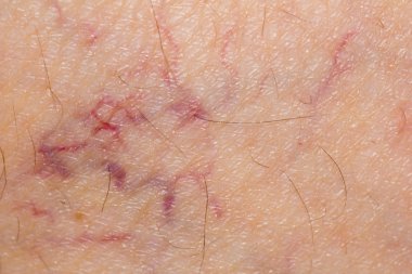 Deride varis damarları var. makro