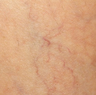 Deride varis damarları var. makro