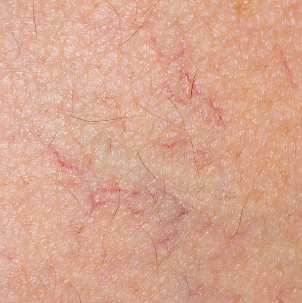 Krampfadern auf der Haut. Makro — Stockfoto