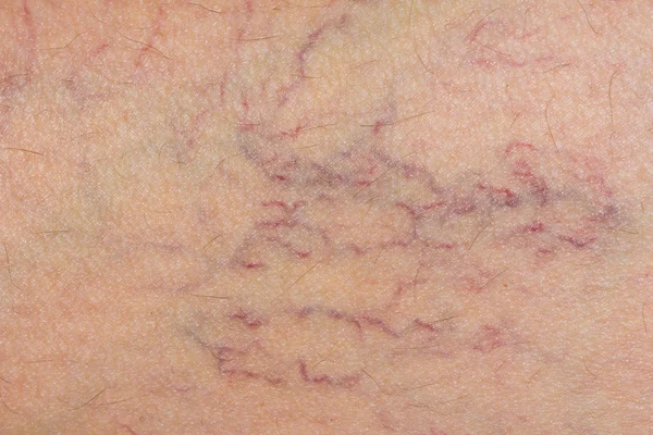 Varicose veins on the skin. Macro — Stock Photo, Image
