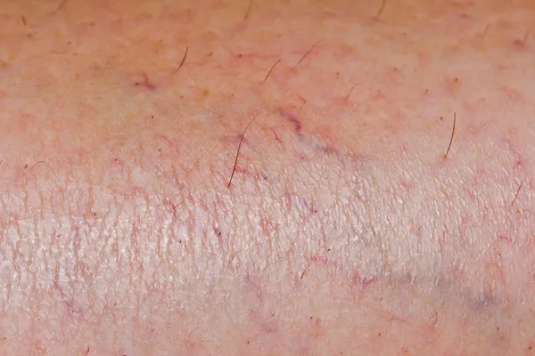 Varicose veins on the skin. Macro — Stock Photo, Image