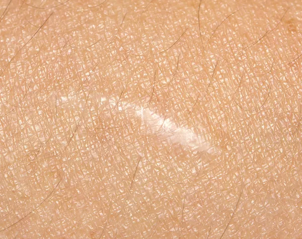 Scar on the skin. macro — Stock Photo, Image