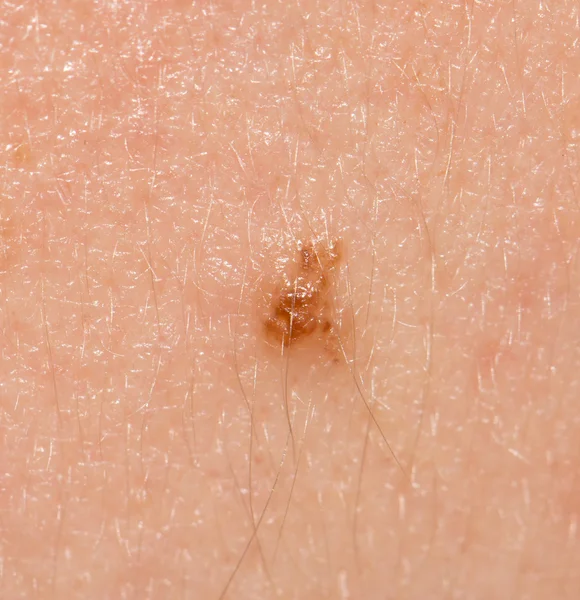 Sebuah tahi lalat pada kulit. makro — Stok Foto