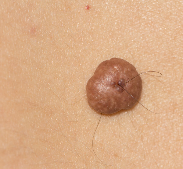 A mole on the skin. macro