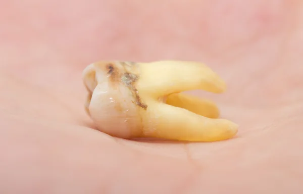 Dente — Fotografia de Stock