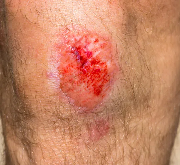 Wond op een knie — Stockfoto