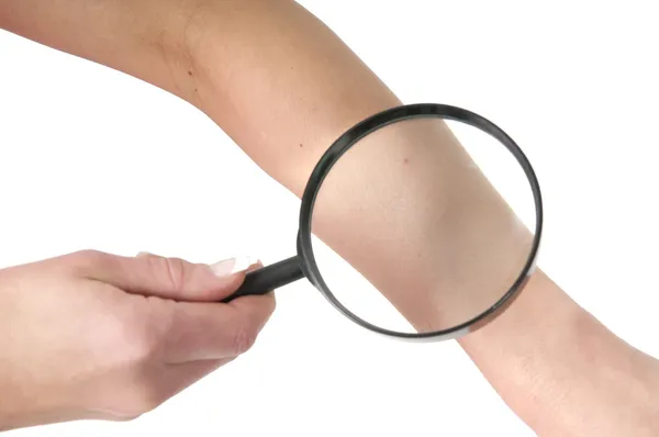 Healthy skin check with loupe on arm — Stock Photo, Image