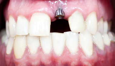 dental implant clipart
