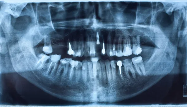 Radiografia dentale — Foto Stock