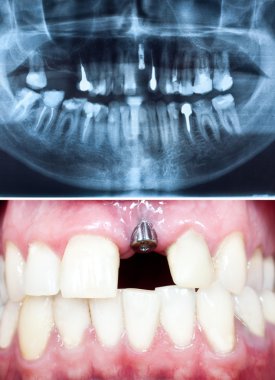 diş implantı