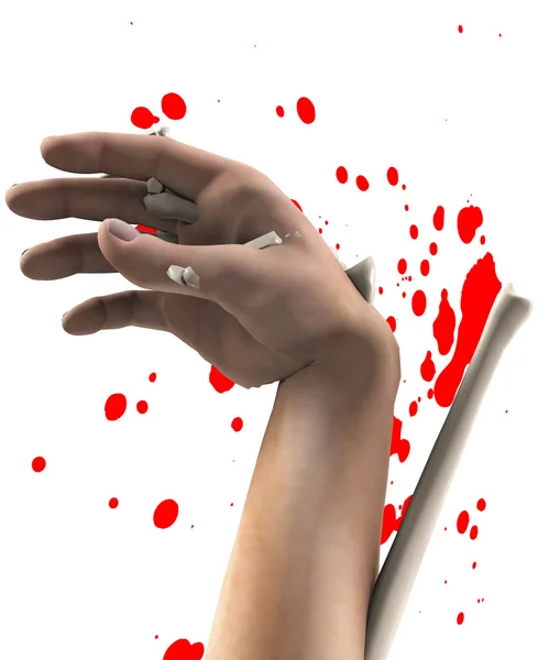 Schreckliche Handverletzung — Stockfoto