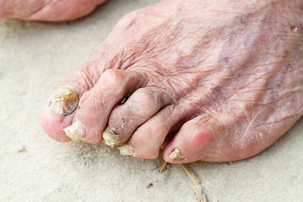 Patients legs — Stock Photo, Image