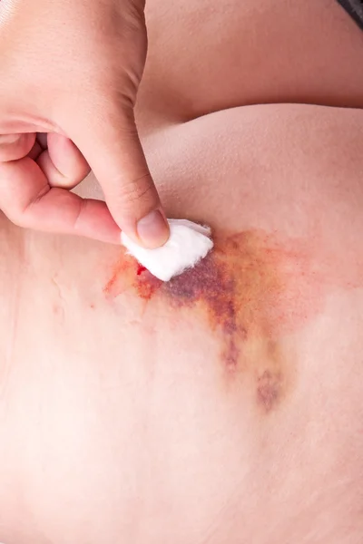 Hematoma from the injection — Stock Photo, Image