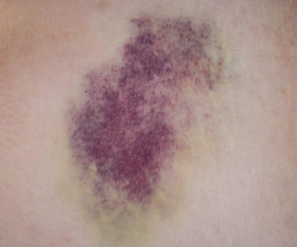 Large Bruise Person Body Close — Stock Photo, Image