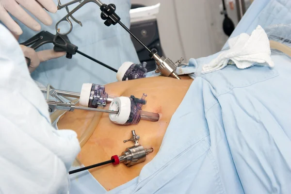 Gastrik bypass cerrahisi