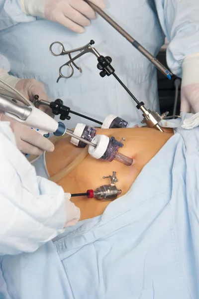 Gastrik bypass cerrahisi