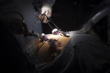 Gastrik bypass cerrahisi