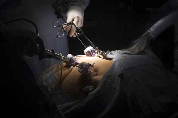 Gastrik bypass cerrahisi