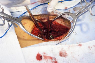 Surgical procedure clipart