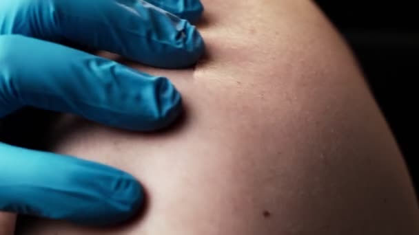 Huidprobleem Gordelroos Een Handschoenhand Voelt Aangetaste Huid Huidverzorging Dermatologie — Stockvideo