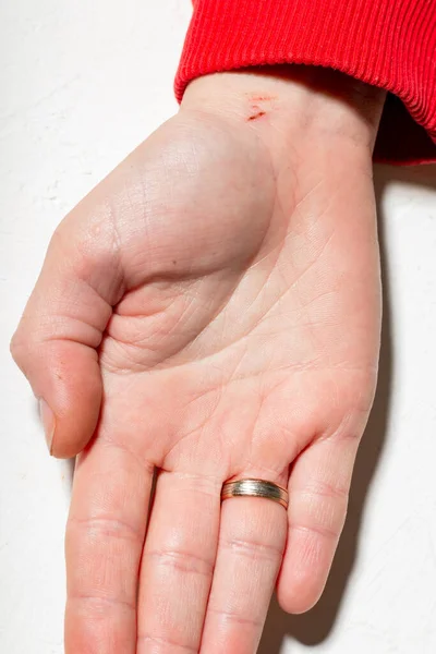 Χέρι Μιας Γυναίκας Μια Μικρή Γρατζουνιά Γυναικείο Χέρι Βέρα Λευκό — Φωτογραφία Αρχείου